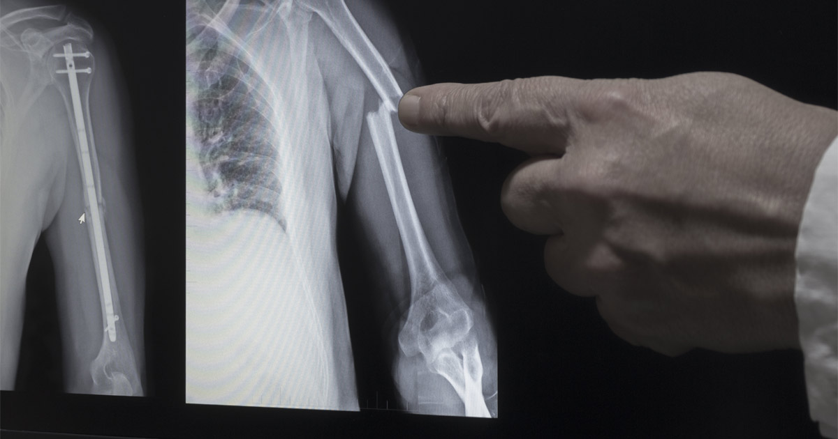 What Are the Most Common Broken Bones and Fractures That Are Caused by Car Accidents?